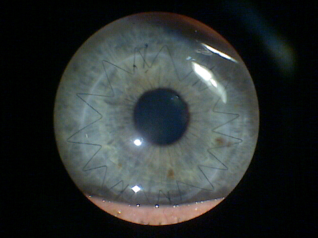 Corneal Transplant