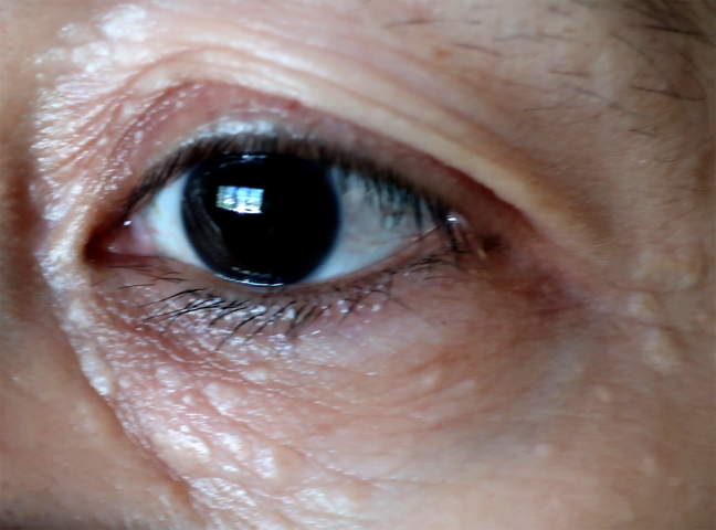 Syringoma
